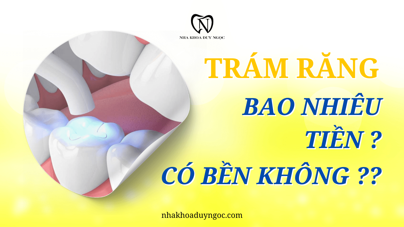 trám răng