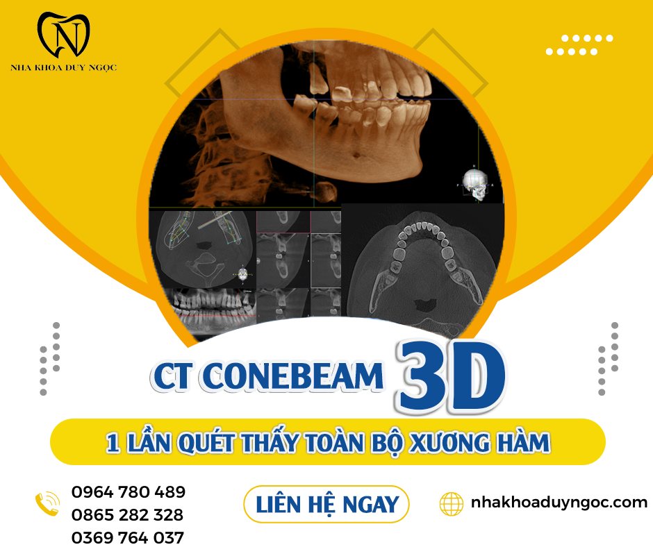 chụp phim ct cone beam