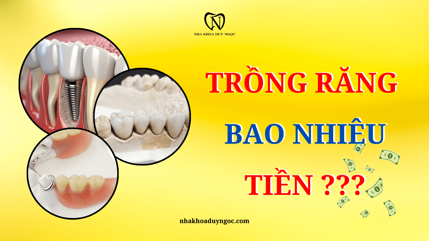 TRỒNG RĂNG BAO NHIÊU TIỀN