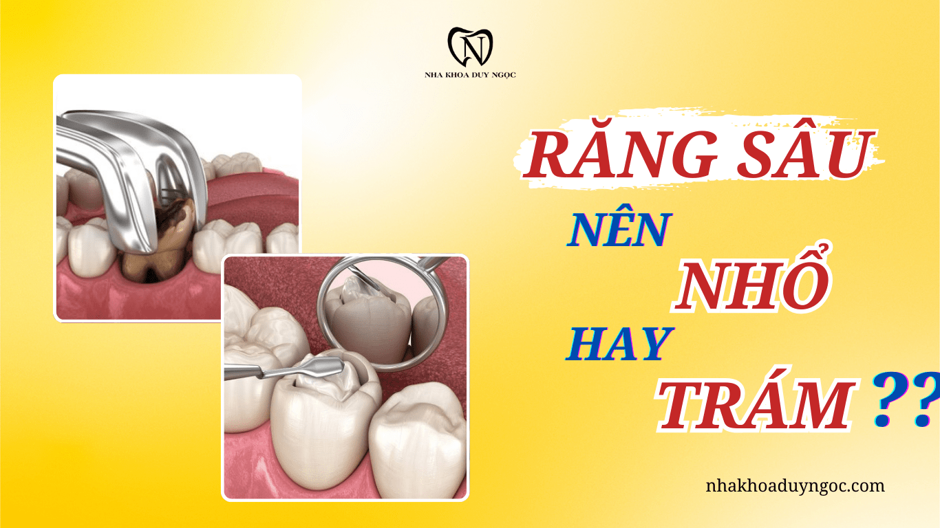 răng sâu nên nhổ hay trám