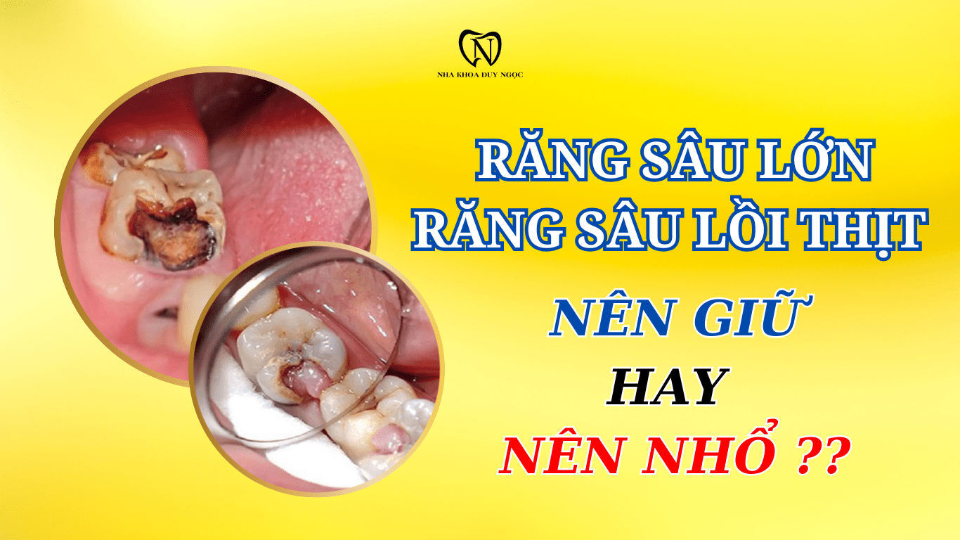 RĂNG SÂU LỚN CÓ GIỮ LẠI ĐƯỢC KHÔNG