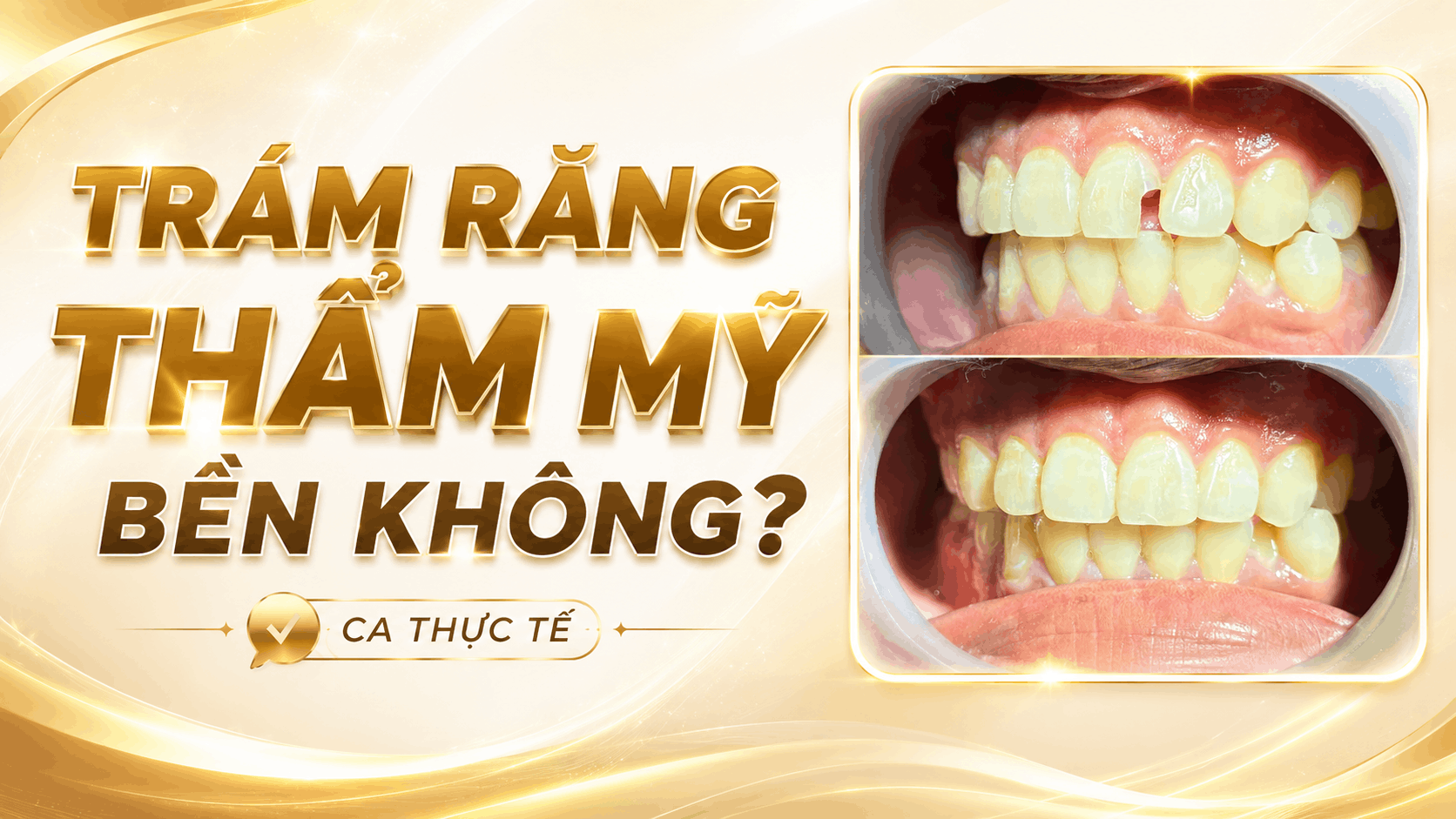 trám răng thẩm mỹ có bền không